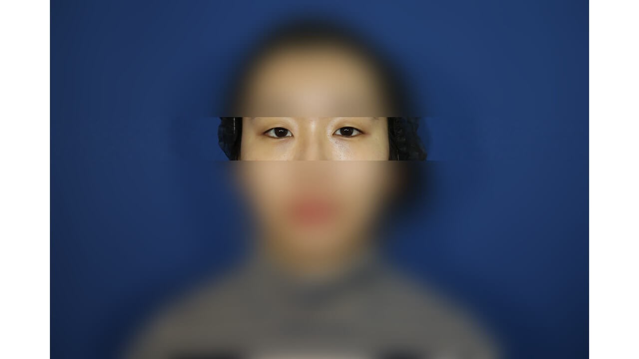 Lower Eyelid Surgery After