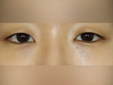 Lower Eyelid Surgery After