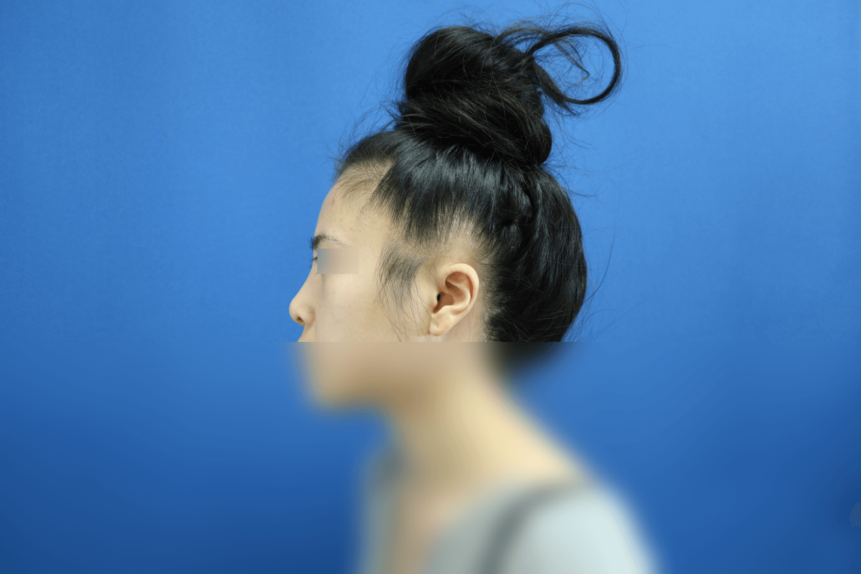 Rhinoplasty After