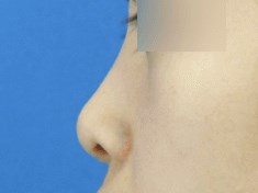Rhinoplasty After