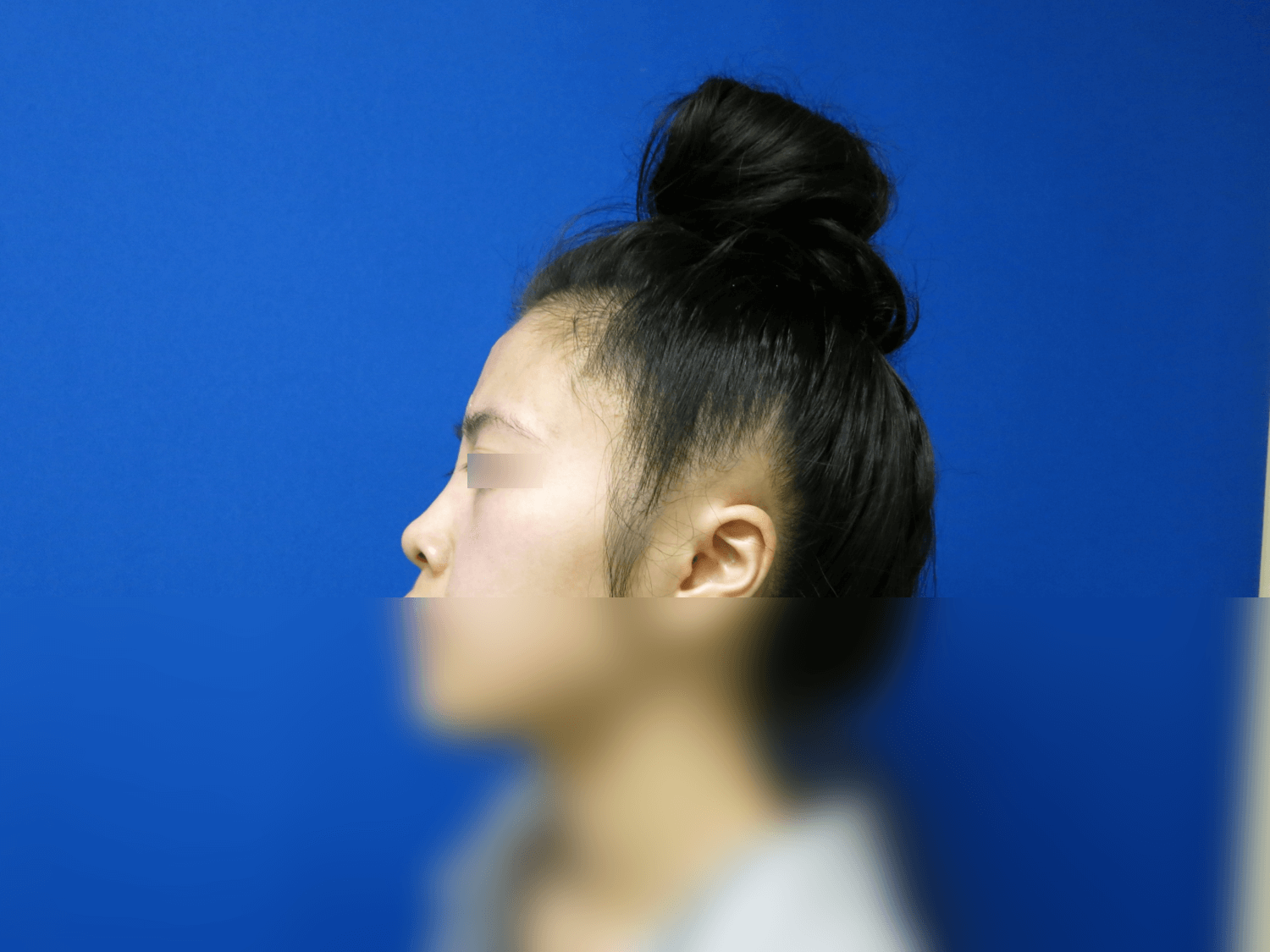 Rhinoplasty Before