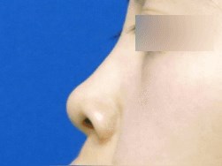 Rhinoplasty Before