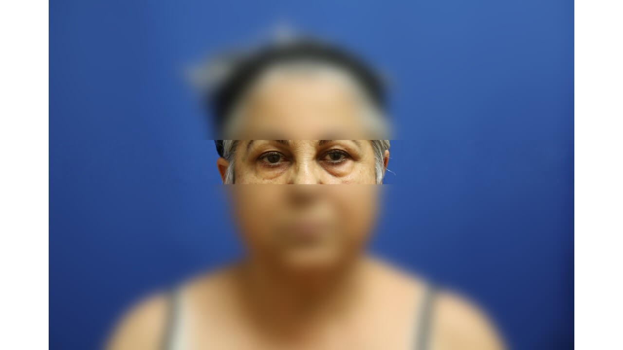 Lower Eyelid Surgery Before