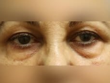 Lower Eyelid Surgery Before