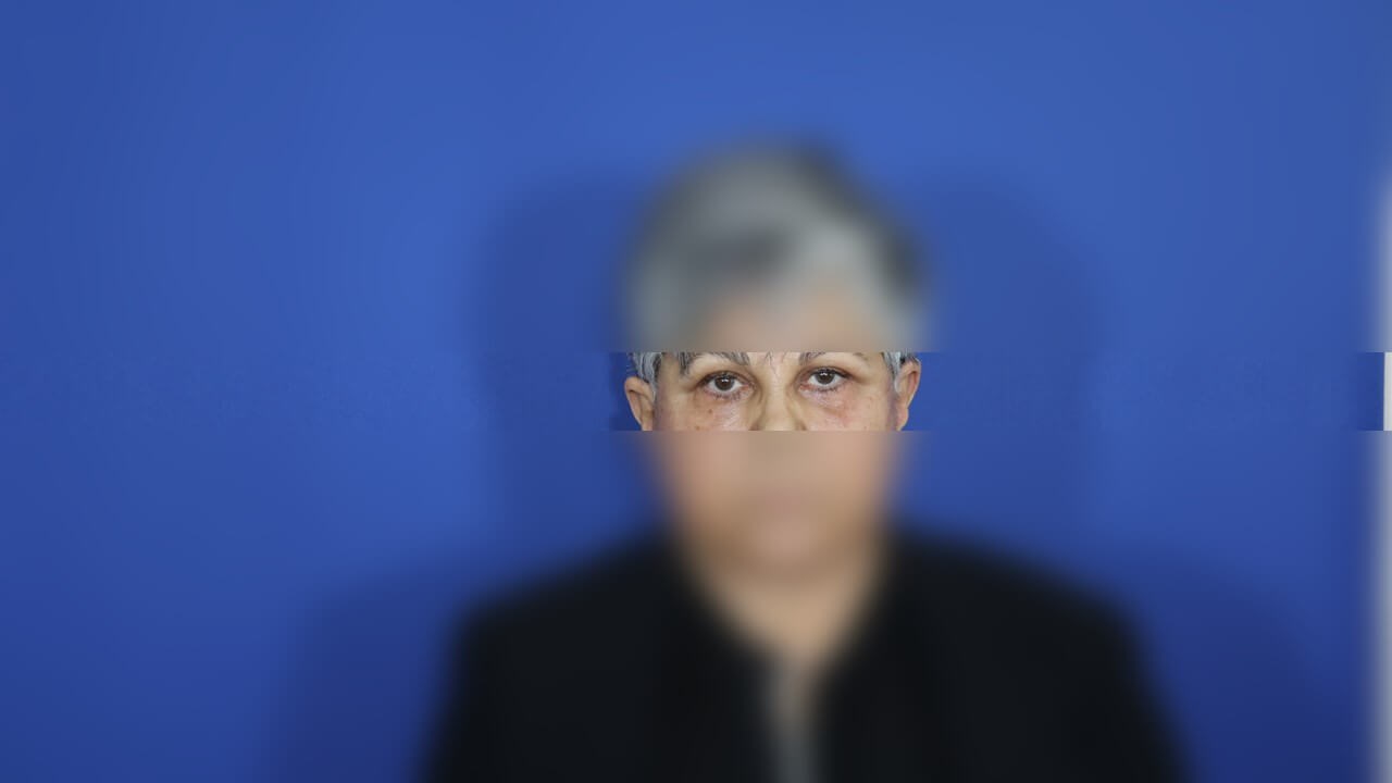 Lower Eyelid Surgery After