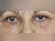 Lower Eyelid Surgery After