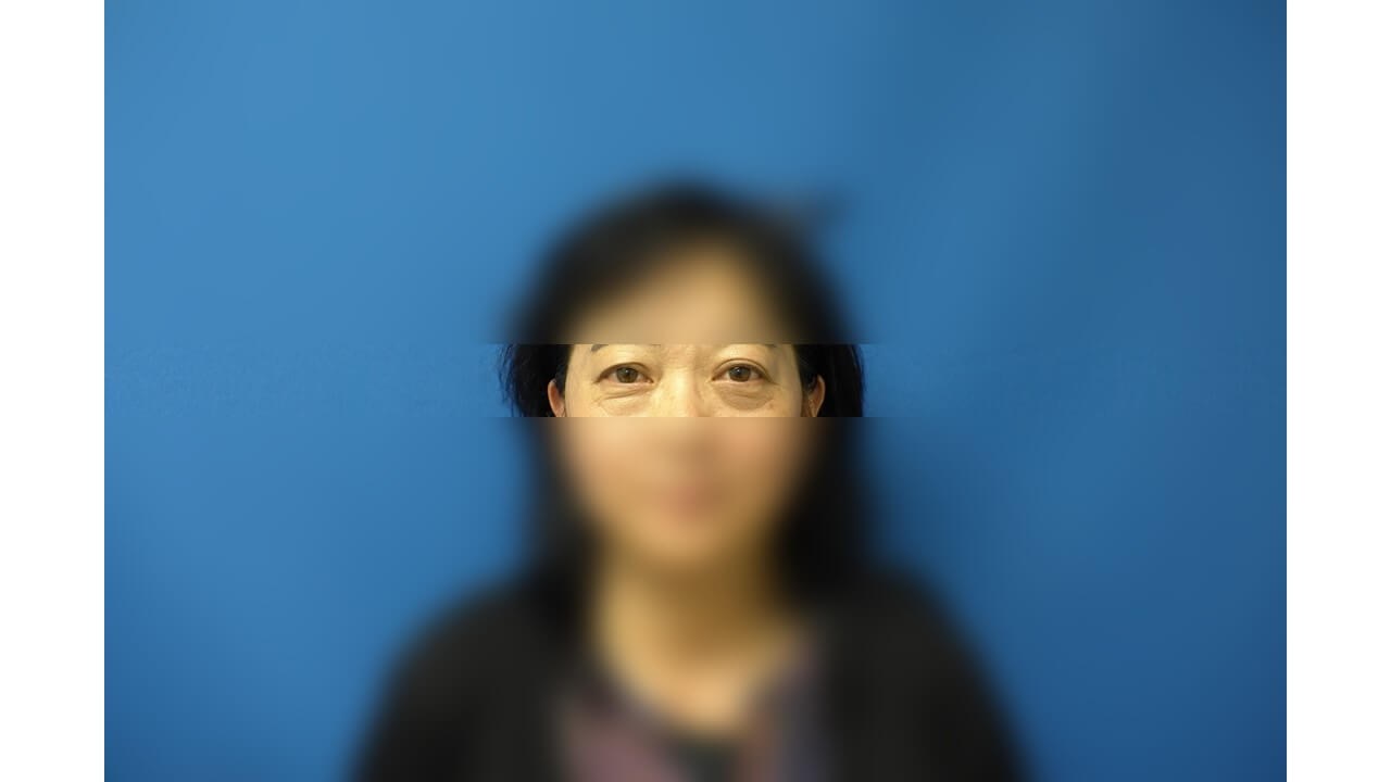 Lower Eyelid Surgery Before