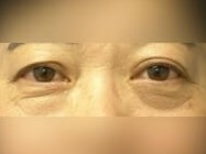 Lower Eyelid Surgery Before