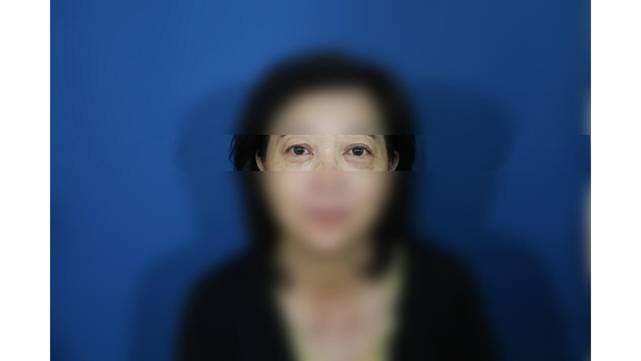 Lower Eyelid Surgery After