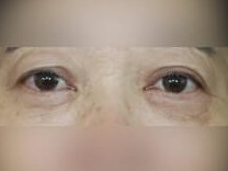Lower Eyelid Surgery After