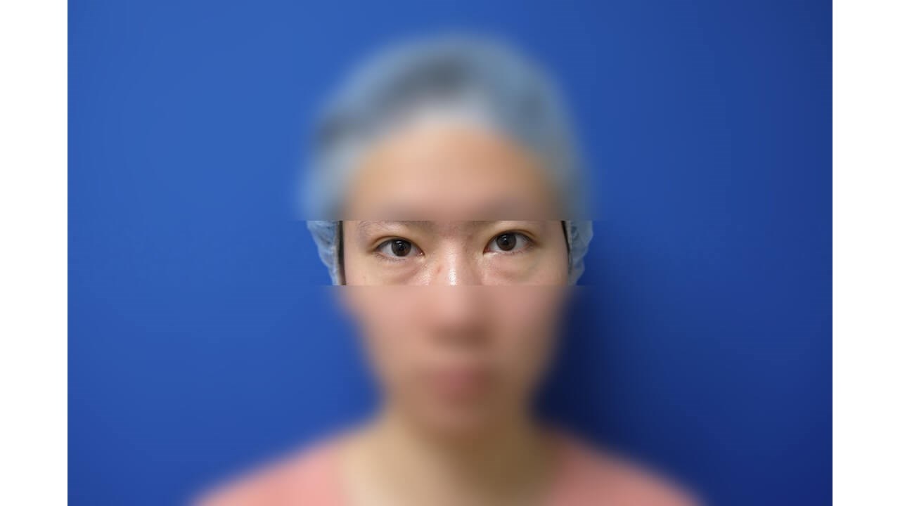 Lower Eyelid Surgery Before