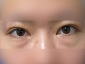 Lower Eyelid Surgery Before