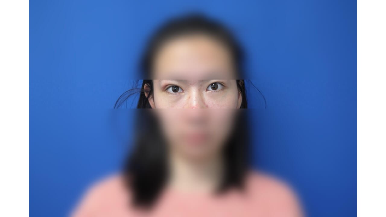 Lower Eyelid Surgery After