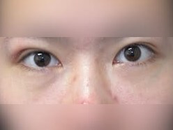 Lower Eyelid Surgery After