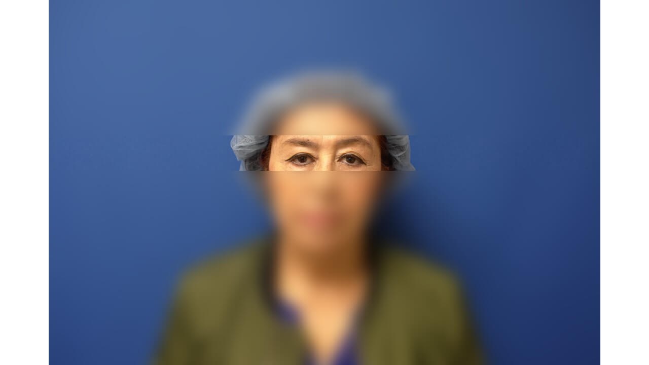 Upper Eyelid Surgery Before
