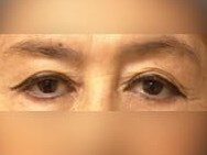Upper Eyelid Surgery Before