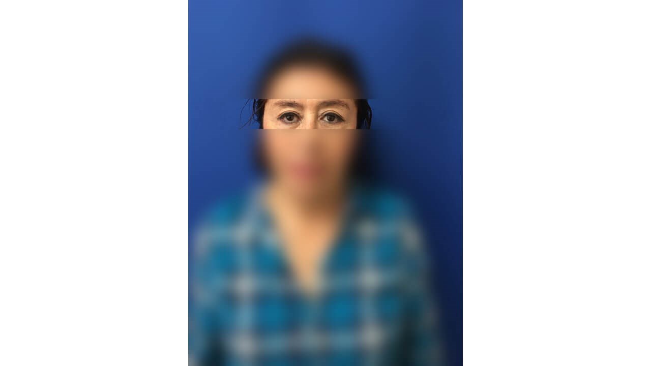 Upper Eyelid Surgery After