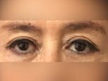 Upper Eyelid Surgery After