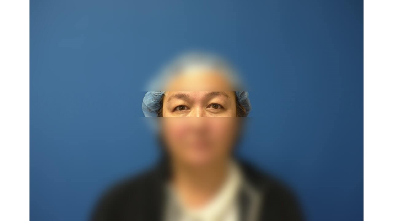 Upper Eyelid Surgery Before