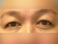 Upper Eyelid Surgery Before