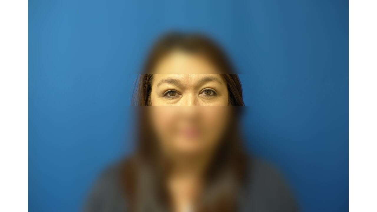 Upper Eyelid Surgery After