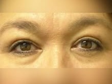 Upper Eyelid Surgery After