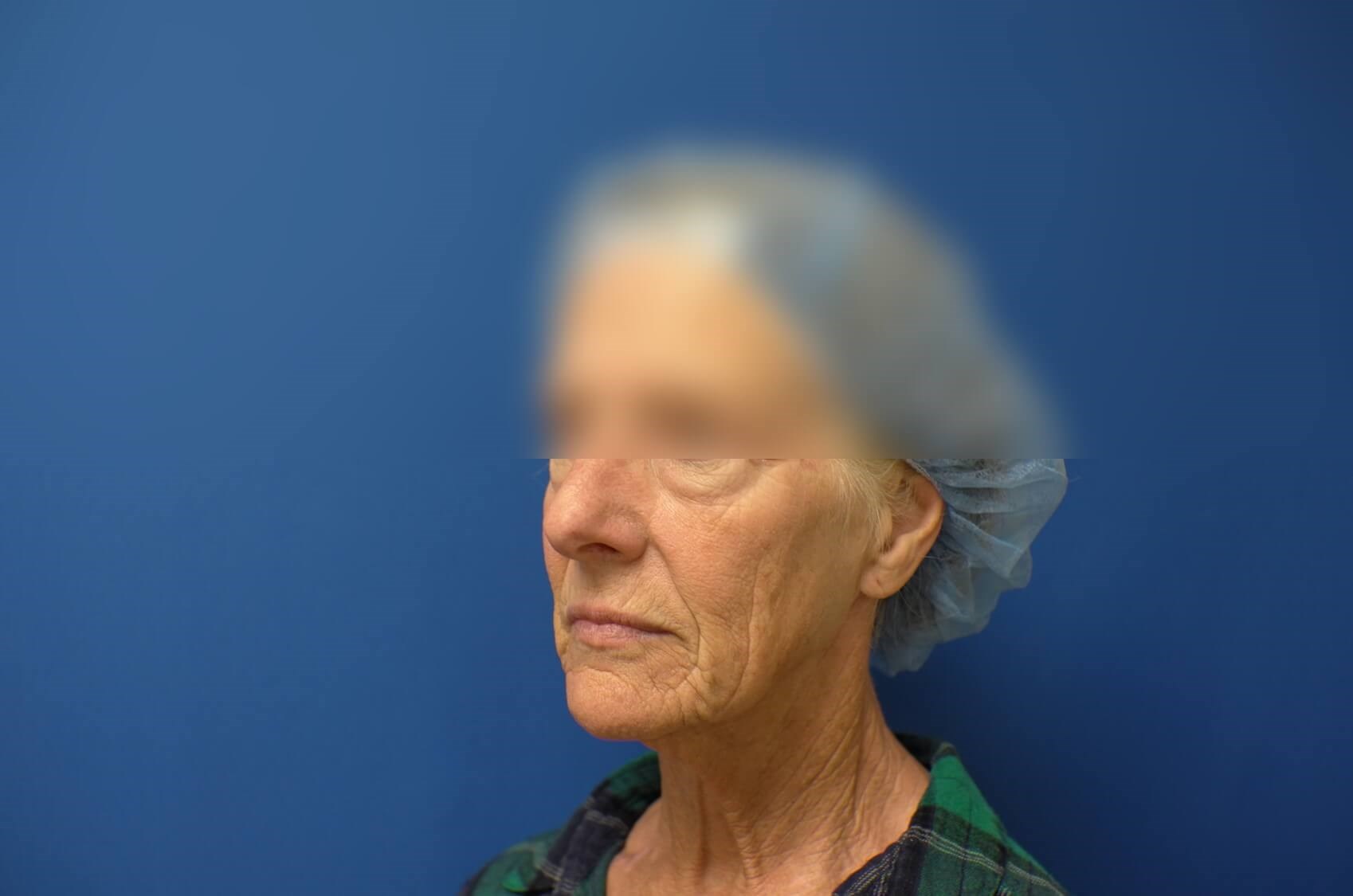 Facelift Before