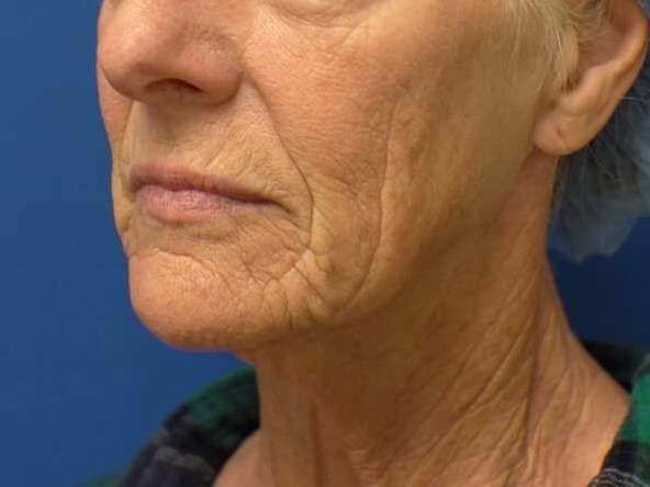 Facelift Before