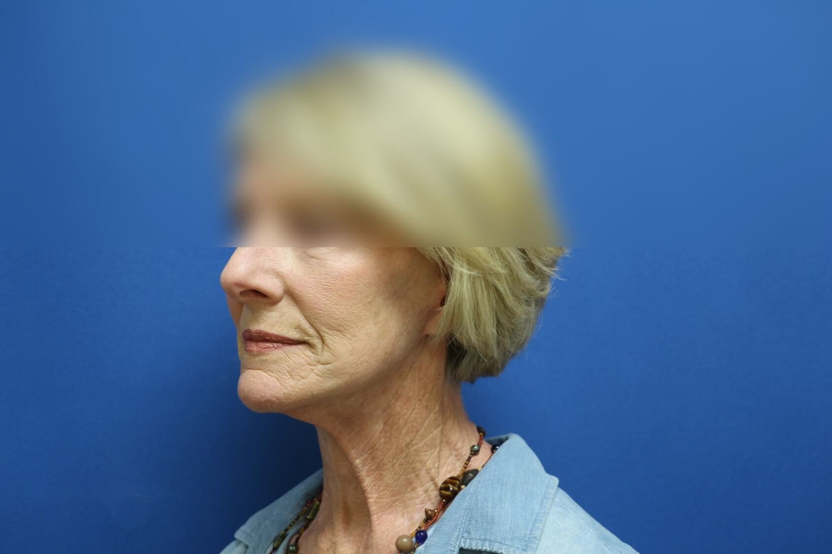 Facelift After