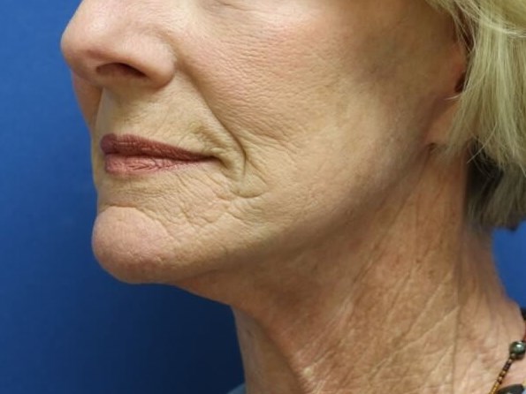 Facelift After