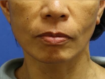 Facelift After