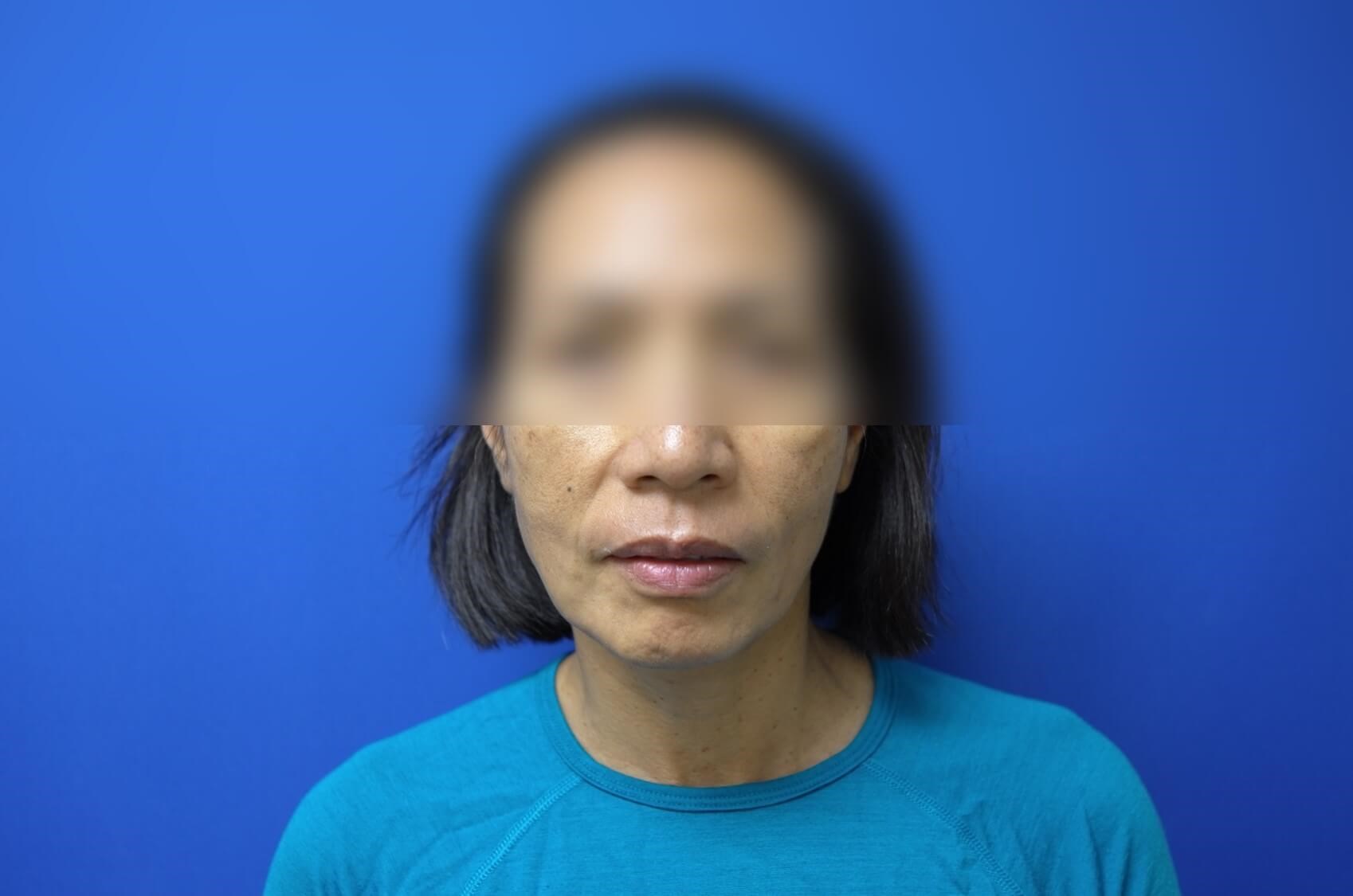 Facelift Before