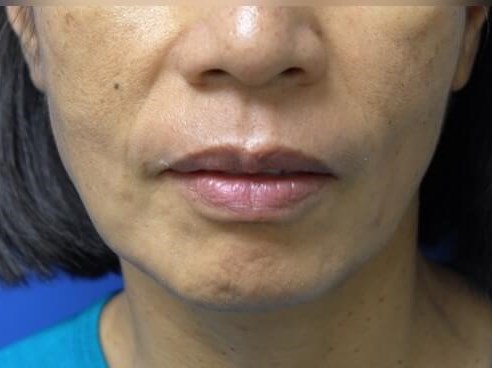 Facelift Before