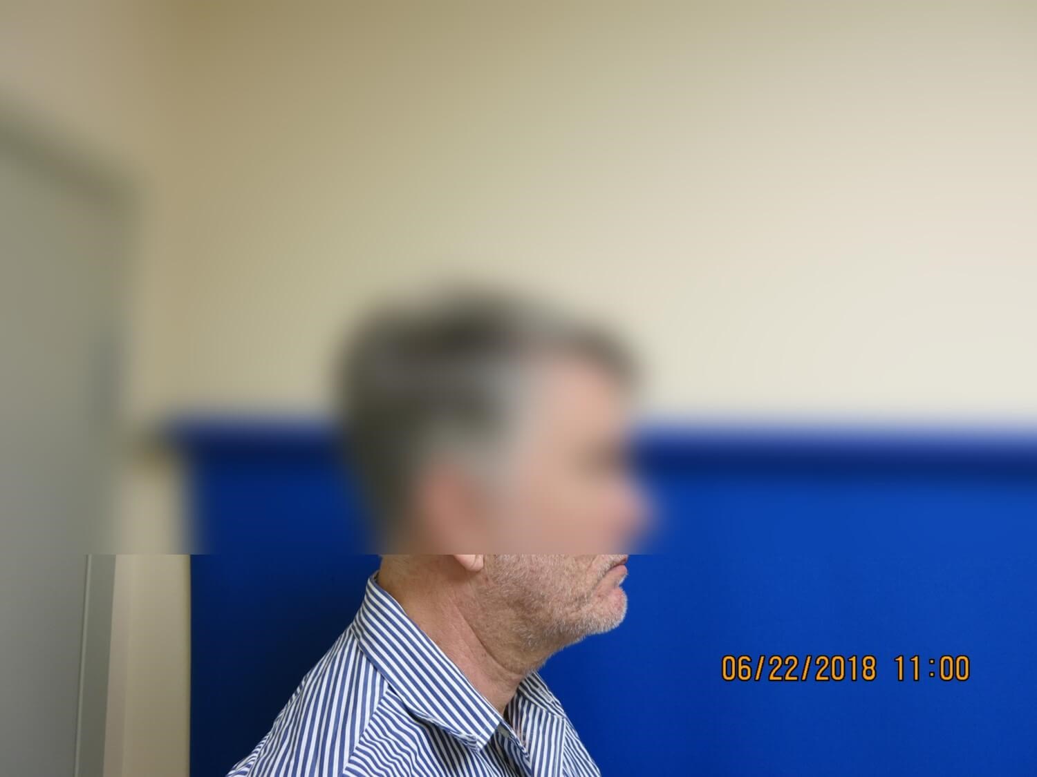 Neck Lift After