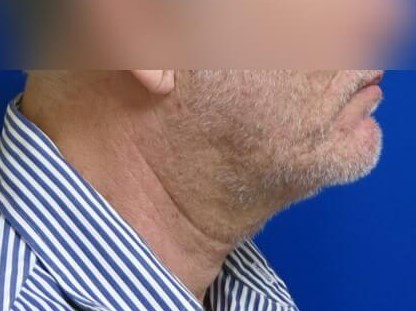 Neck Lift After