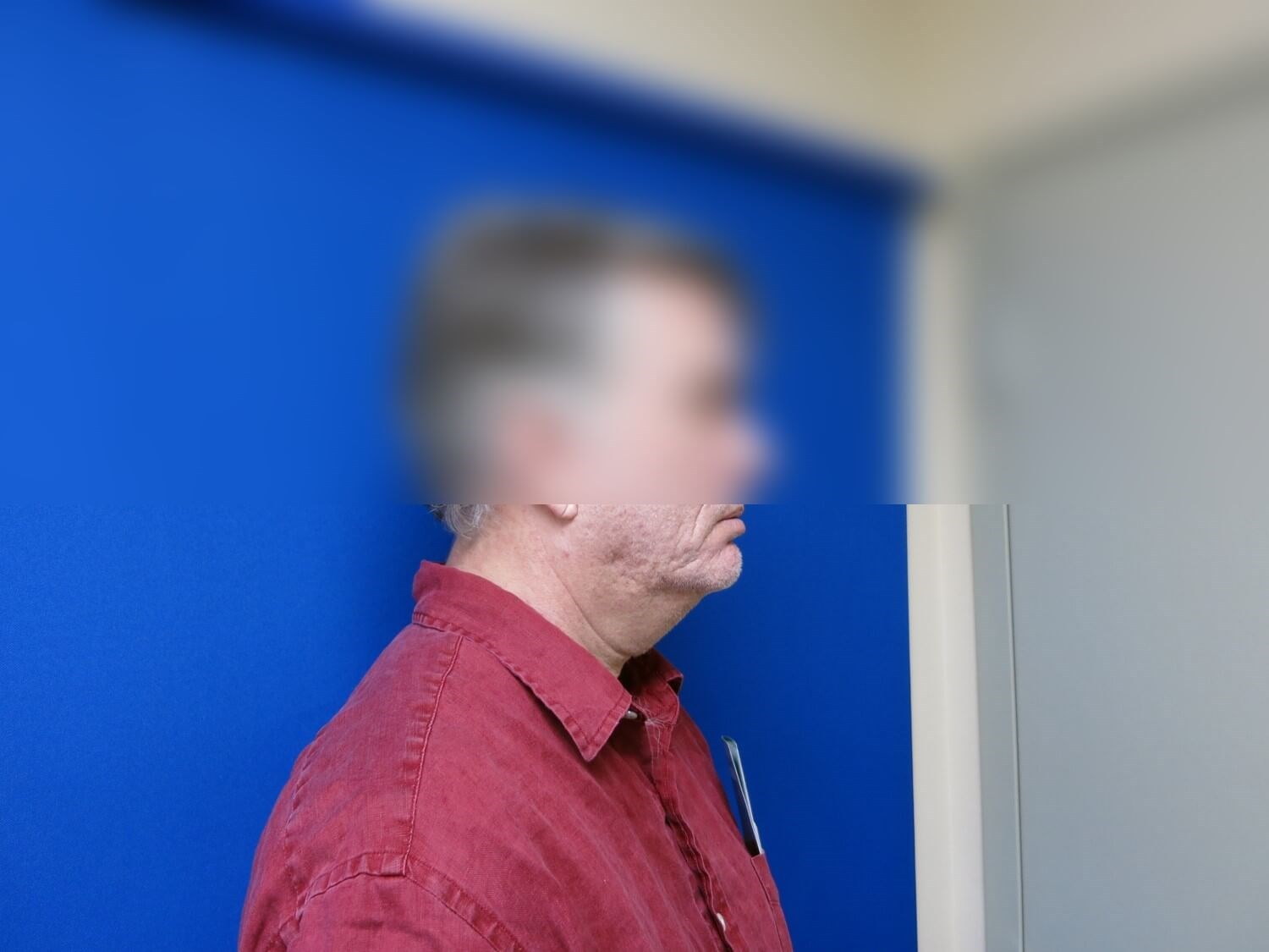 Neck Lift Before