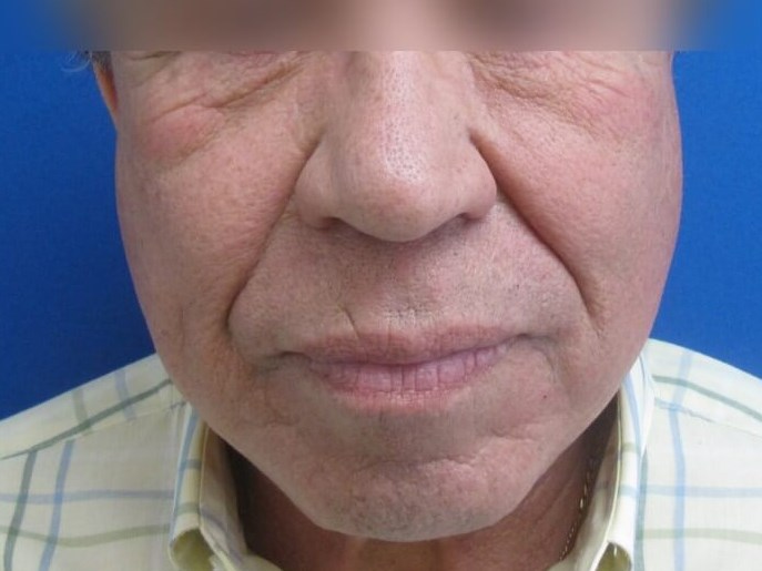 Facial Fat Grafting After