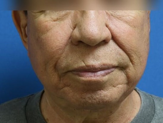 Facial Fat Grafting Before