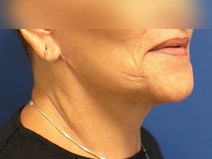 Facelift, Neck Lift, Fat Graft After