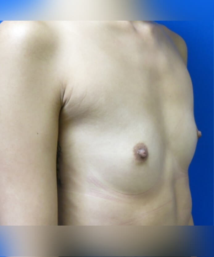 Breast Augmentation Before