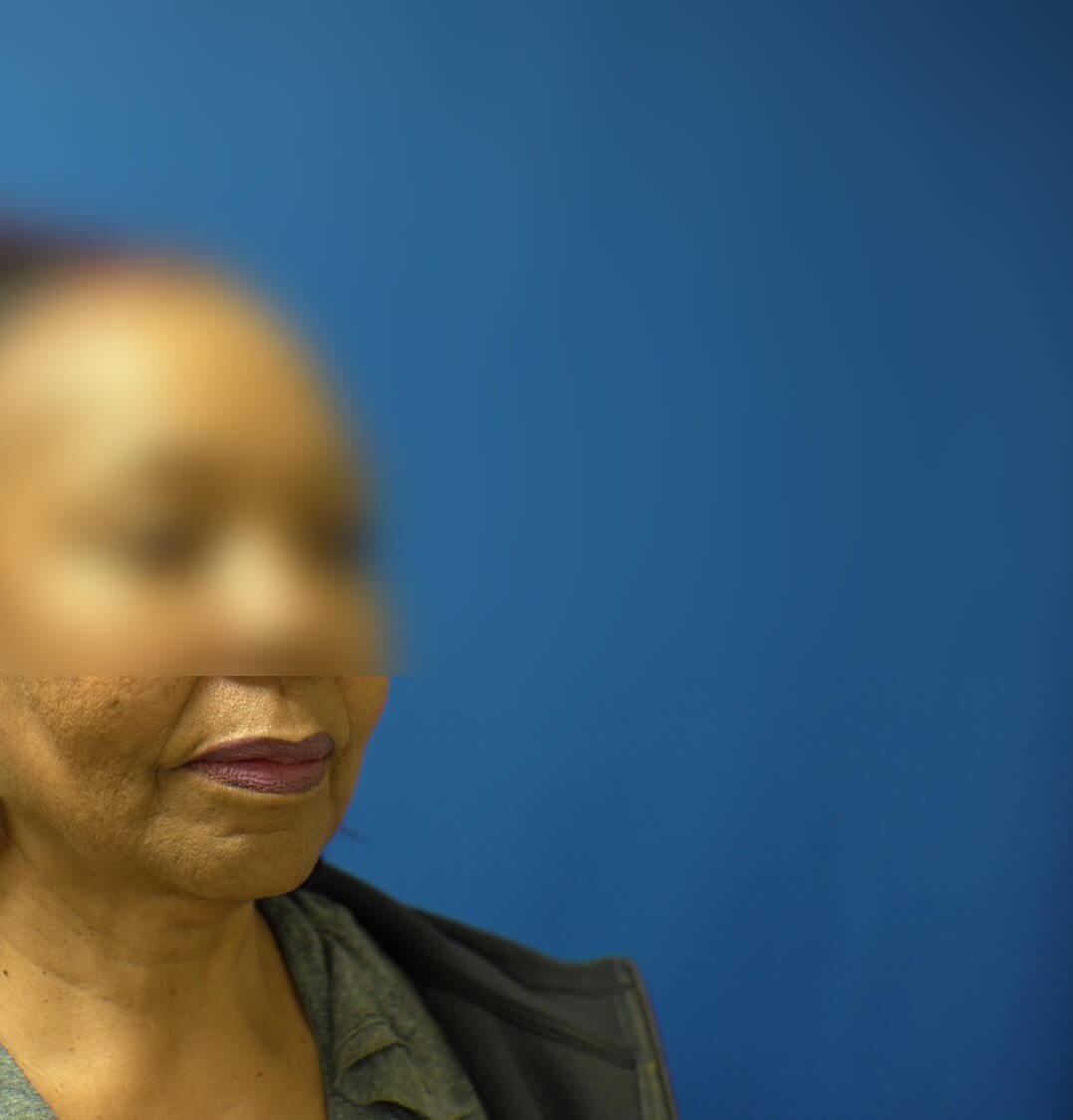 Facelift and Neck Lift Before