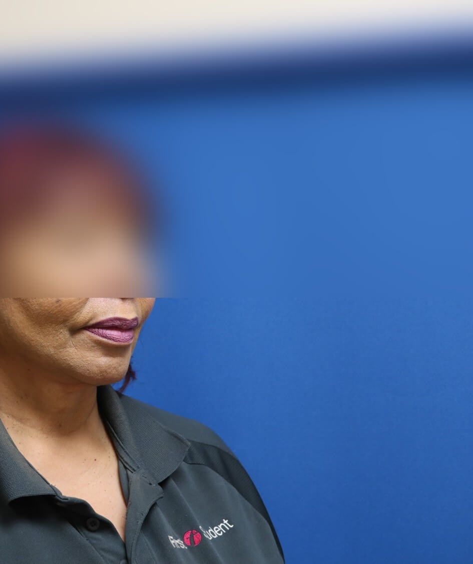 Facelift and Neck Lift After