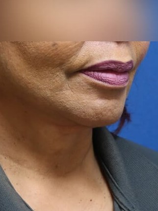 Facelift and Neck Lift After