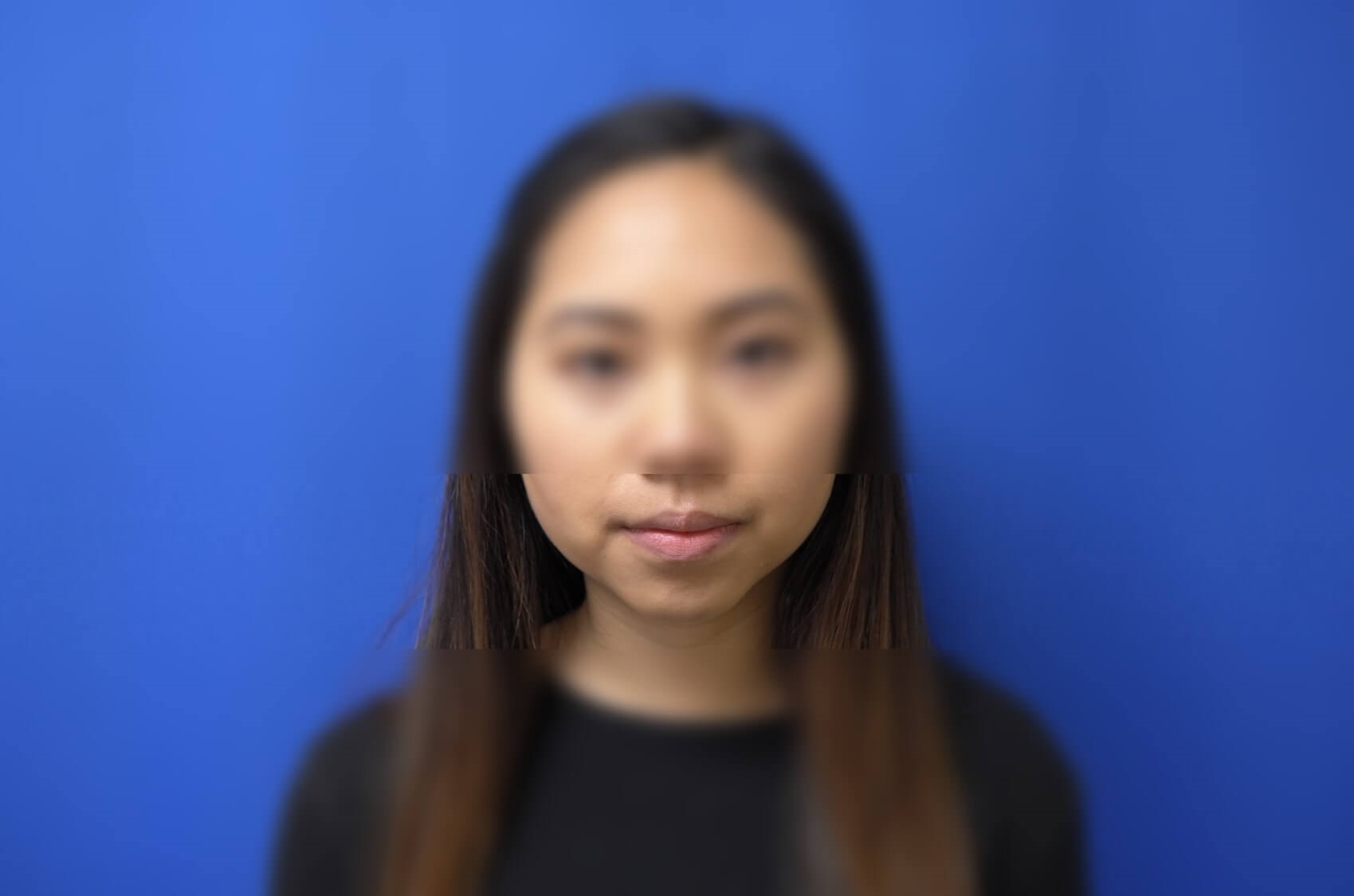 Buccal Fat Removal After