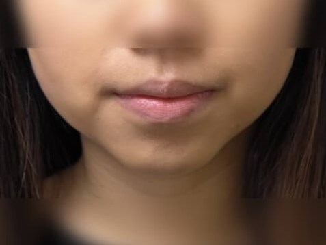 Buccal Fat Removal After