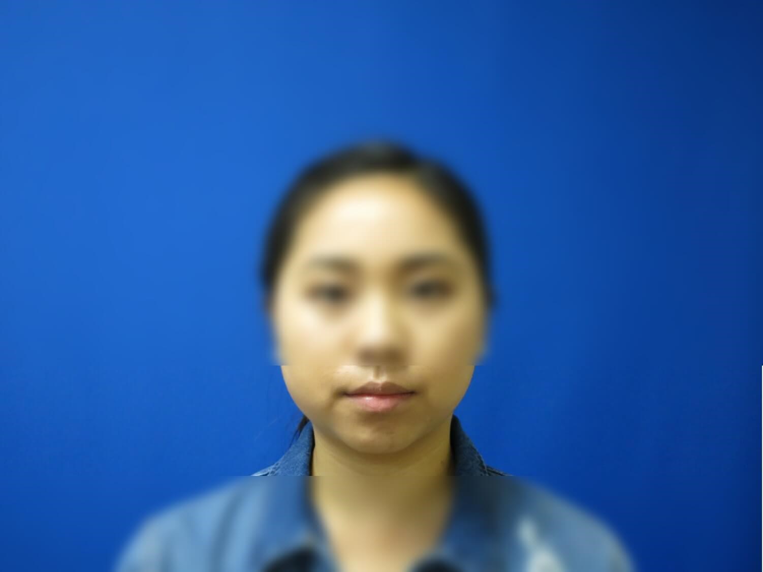 Buccal Fat Removal Before