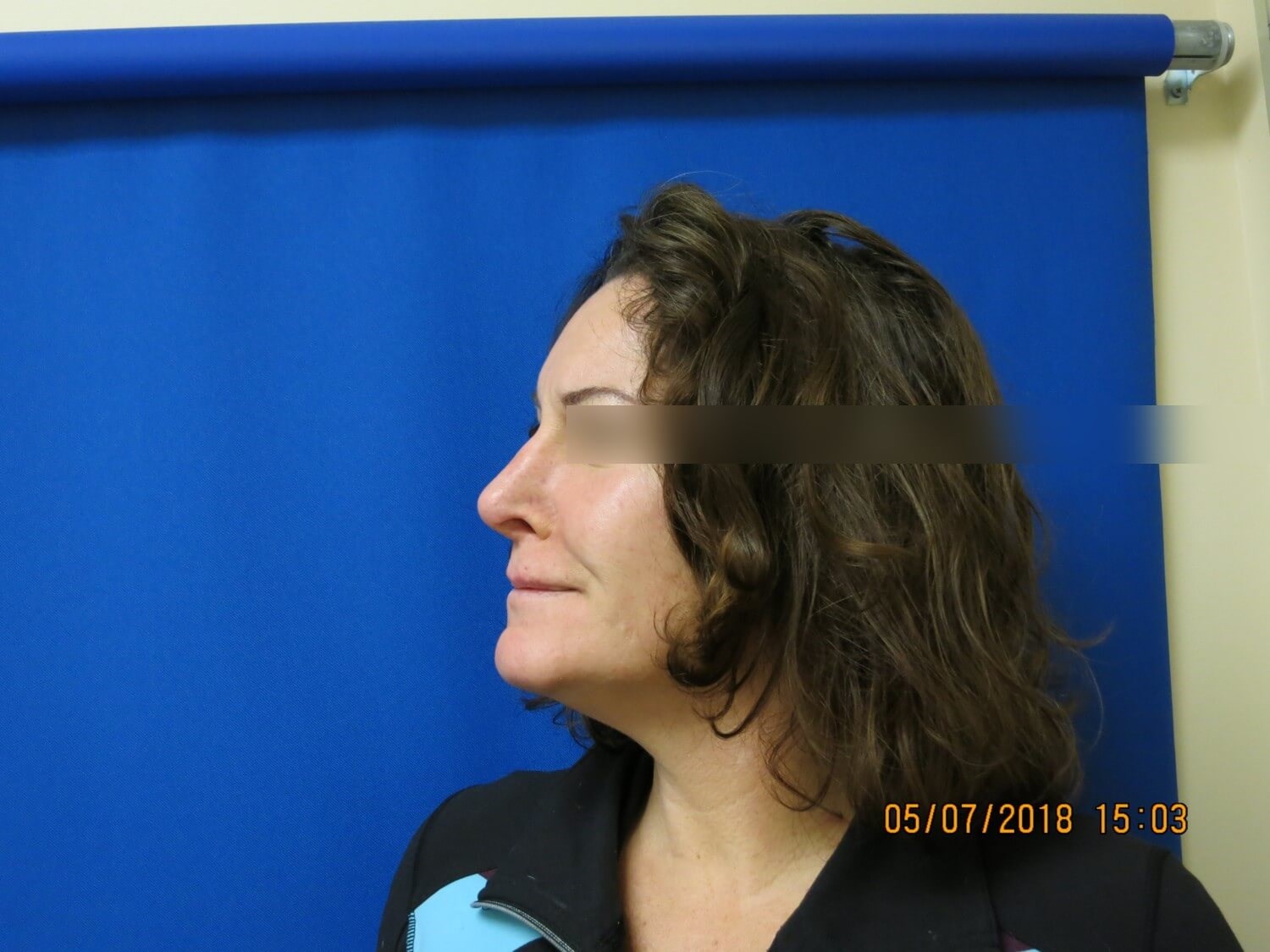 Rhinoplasty and Septoplasty After