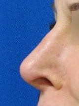 Rhinoplasty and Septoplasty After