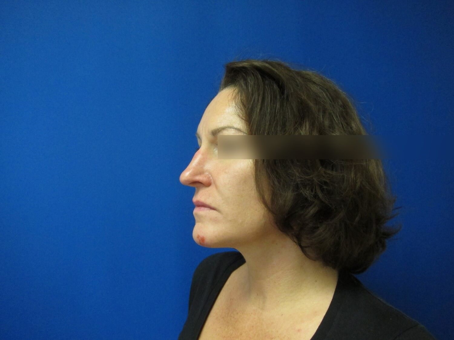Rhinoplasty and Septoplasty Before