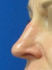Rhinoplasty and Septoplasty Before